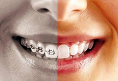 invisalign