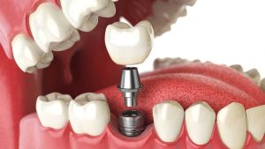 implant